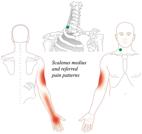 Pattern of left flank pain from the thoracolumbar junction syndrome.