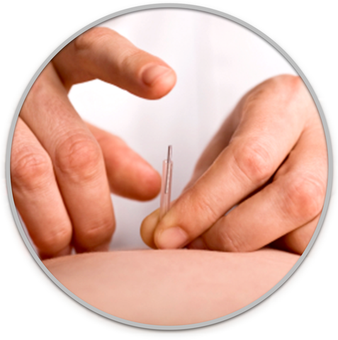 Dry Needling for Trigger Points