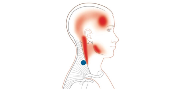 trapezius-trigger-point-interactions