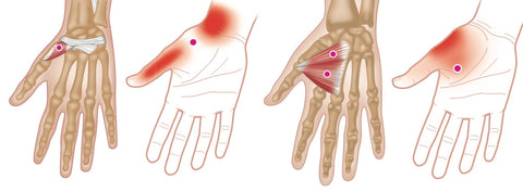 Puntos de activación de la mano y la muñeca