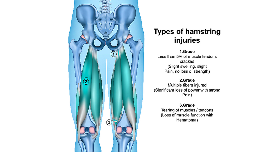 Grades of Hamstring Injury