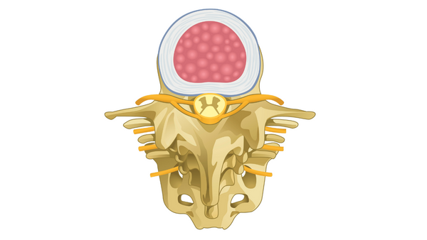 Articulación facetaria y dolor lumbar