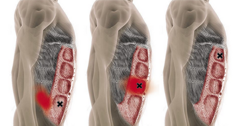 Rectus Abdominis Trigger Points