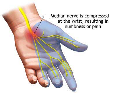 Carpal Tunnel Syndrome Tips for Work