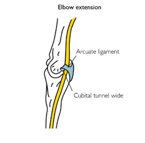 Terapia de puntos gatillo del síndrome del túnel cubital