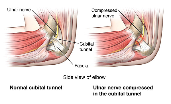 Cubital Tunnel Syndrome Symptoms