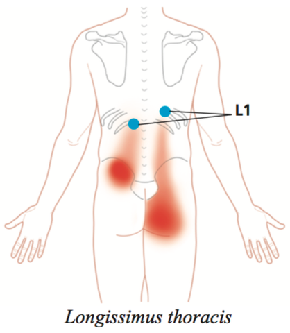 Longissimus Thoracis Trigger Points