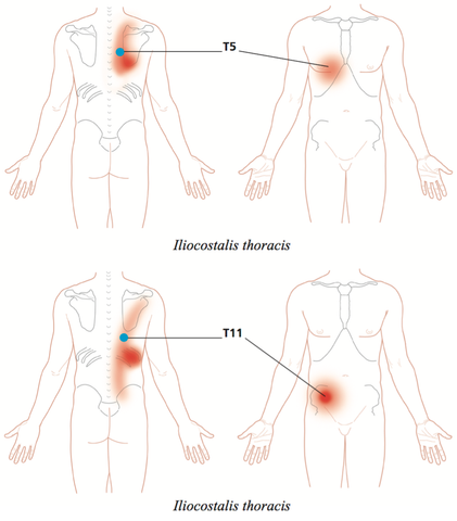 Mapa del dolor de los puntos gatillo del erector de la columna