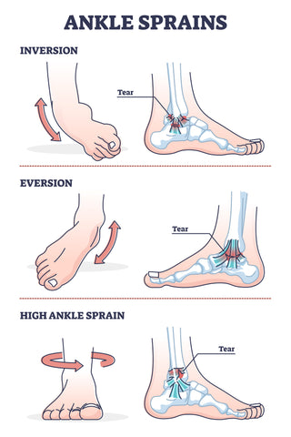 Situaciones de esguince de tobillo con diagrama de contorno de lesión por inversión y eversión. Dolor de pie o pierna torcido e inflamación hinchada con hueso y ligamento