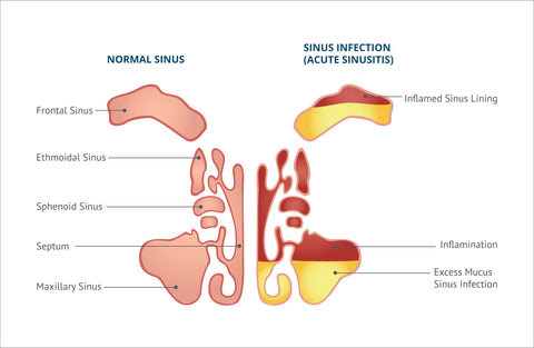 Sinus Infection Image