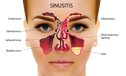 Sinusitis-Bild