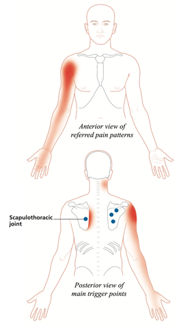 Infraspinatus Triggerpunkt übertragener Schmerz