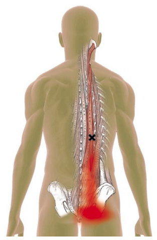 Longissimus Trigger Point Location