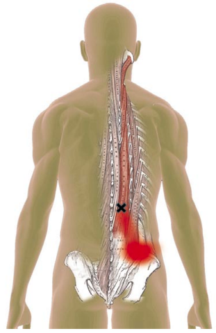 Longissimus Trigger Points