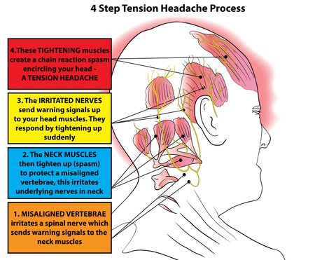 Triggerpunkte bei Kopfschmerzen