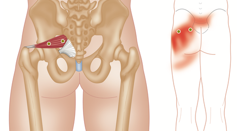 Piriformis Trigger Points and Pain Referral