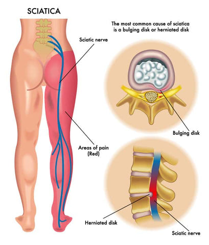 Causas comunes de ciática y dolor ciático