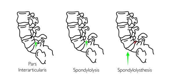 Spndylolisthesis Trigger Point Therapy