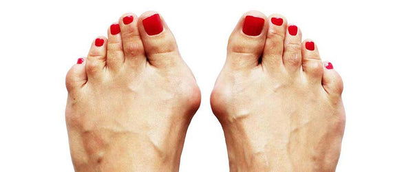 Pieds avec un hallux valgus