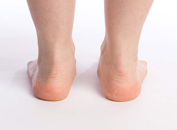 Pieds plats valgus