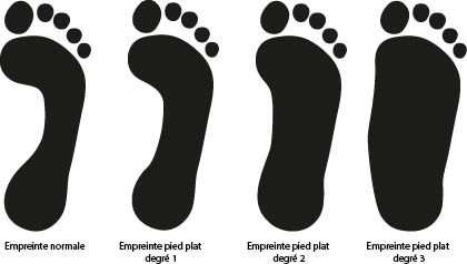 Différents empreintes du pied - forme de pied