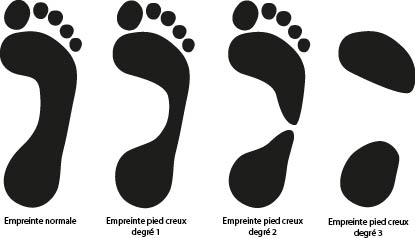 forme empreinte plantaire du pied creux