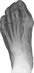 radiographie d'un hallux valgus - déformation du gros orteil