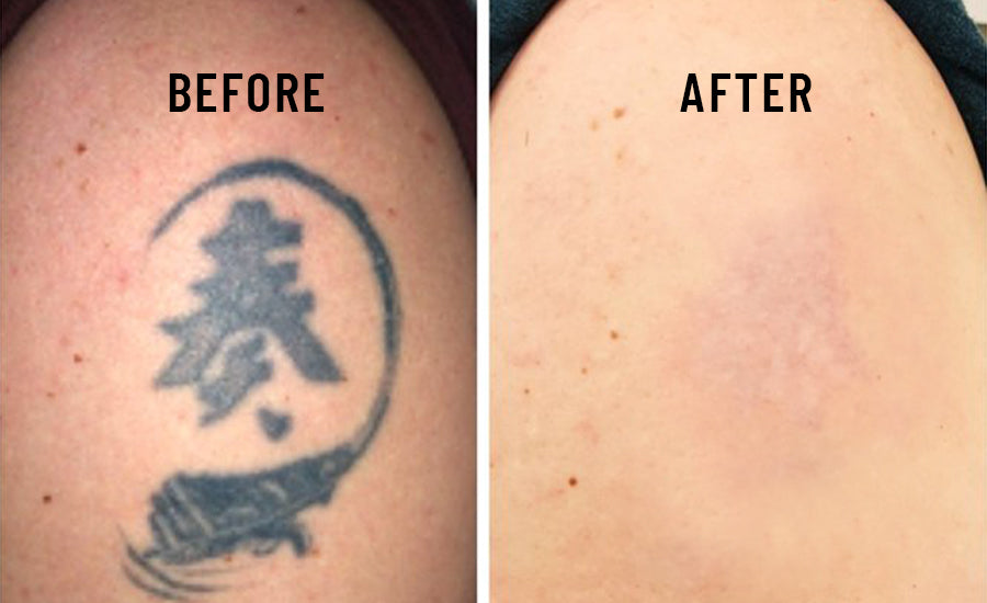 TOP 10 BEST Laser Tattoo Removal in Aurora, CO - Updated 2024 - Yelp