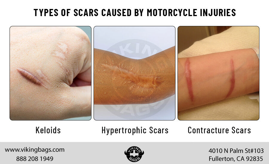 Motorcycle Injury Scar Types