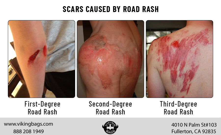 Scars Caused by Road Rash