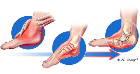 Charcot-Neuroarthropathy-illustration