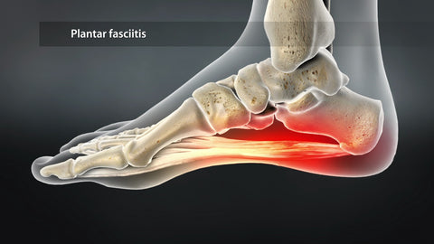 Planter-fasciitis- Inflamed-foot-showing-area-of-pain