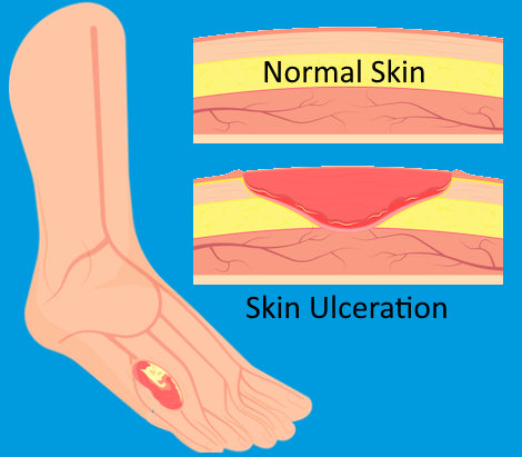 diabetic-foot-ulcer