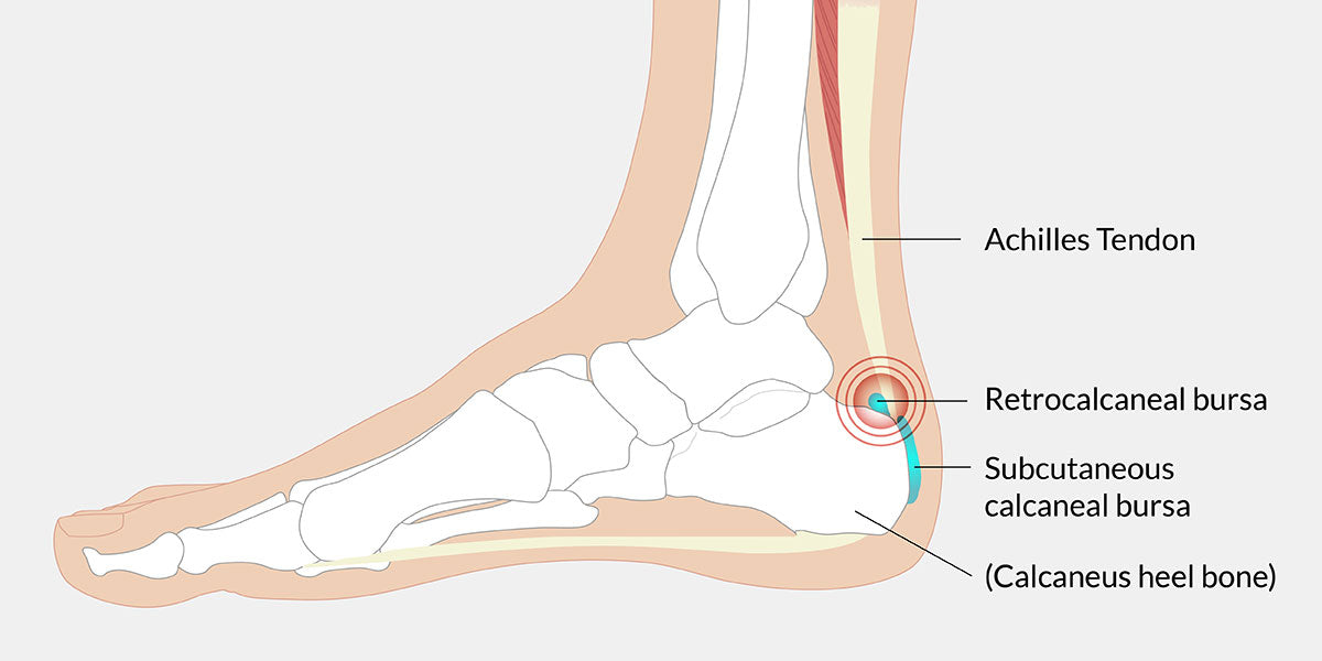 Achilles Bursitis The Complete Injury Guide Vive Health