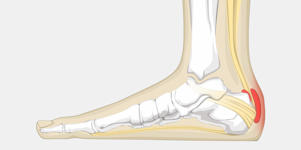 Achilles Bursitis - The Complete Injury 