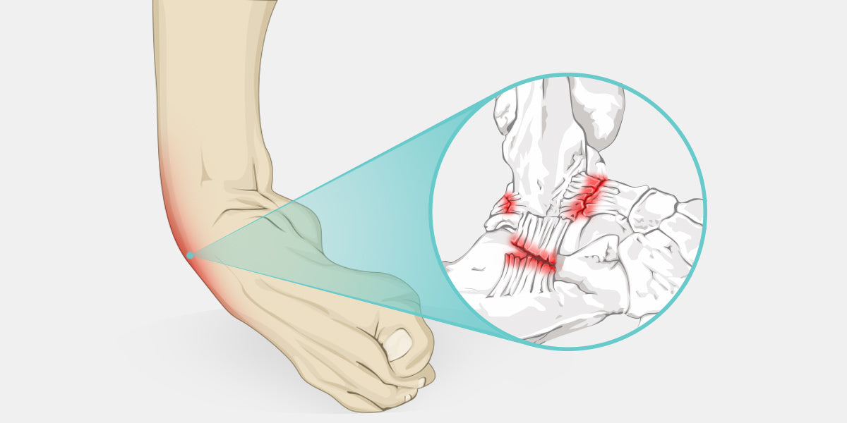 Ankle Instability The Complete Injury Guide Vive Health