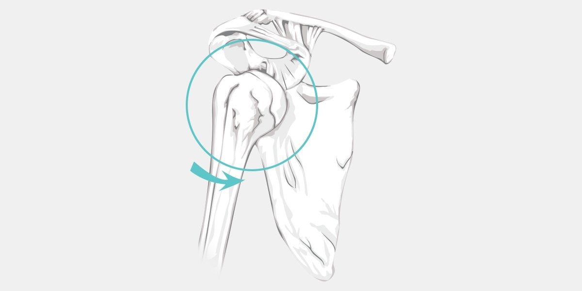 Anterior Shoulder Instability Illustration