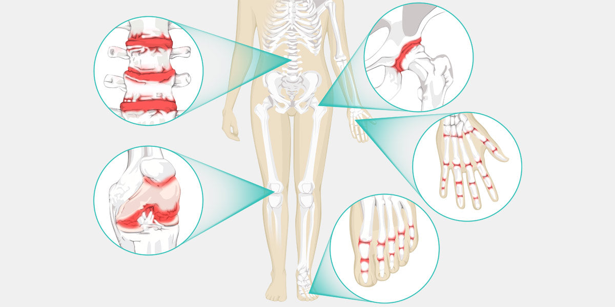 Common arthritis in human body
