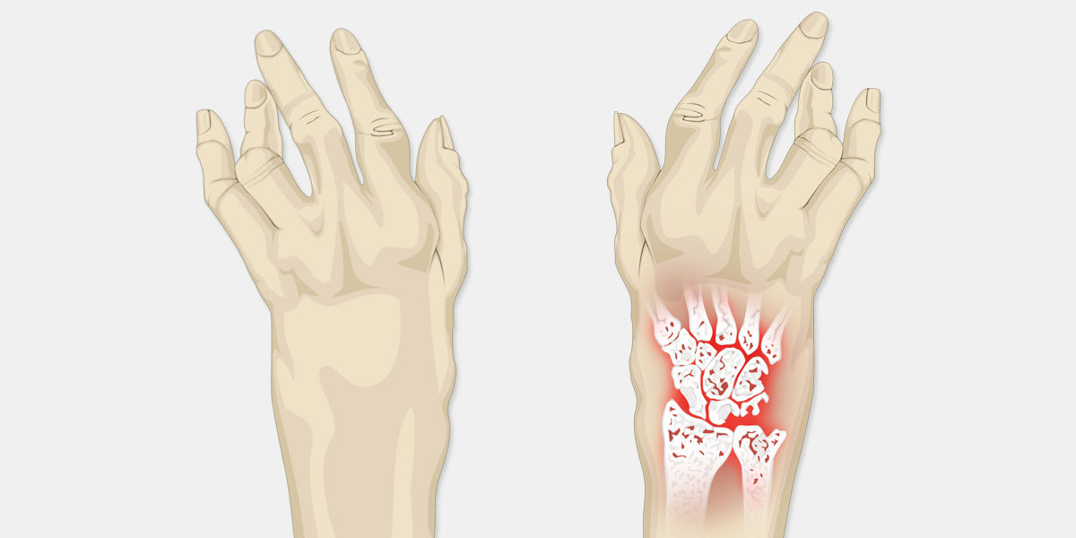 Arthritis of the Wrist - OrthoInfo - AAOS