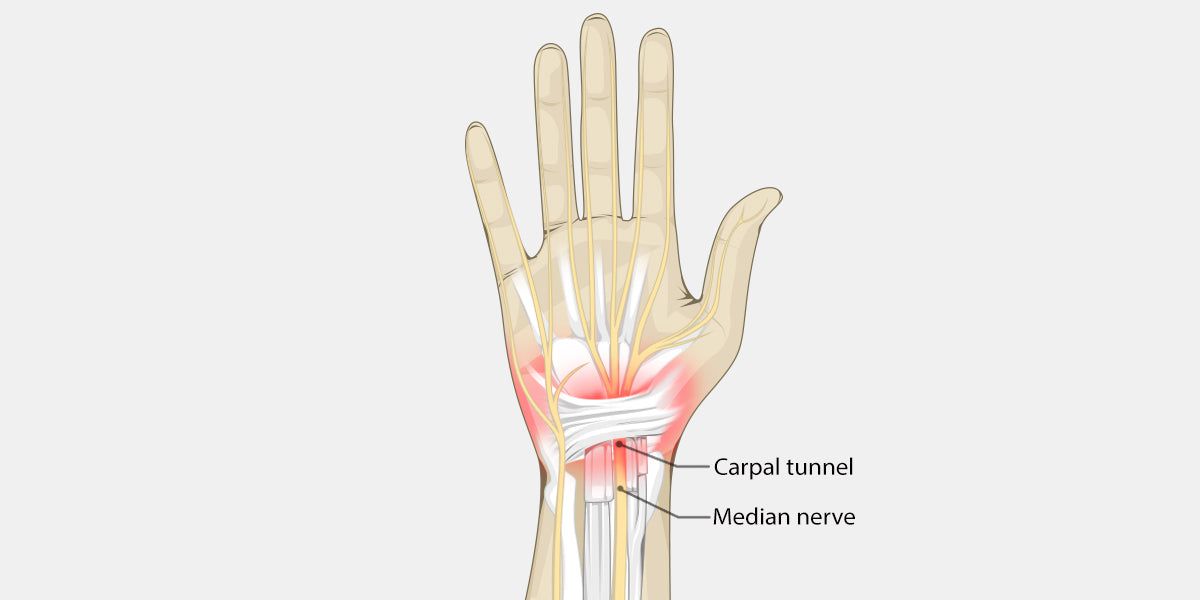 Carpal Tunnel Illustration