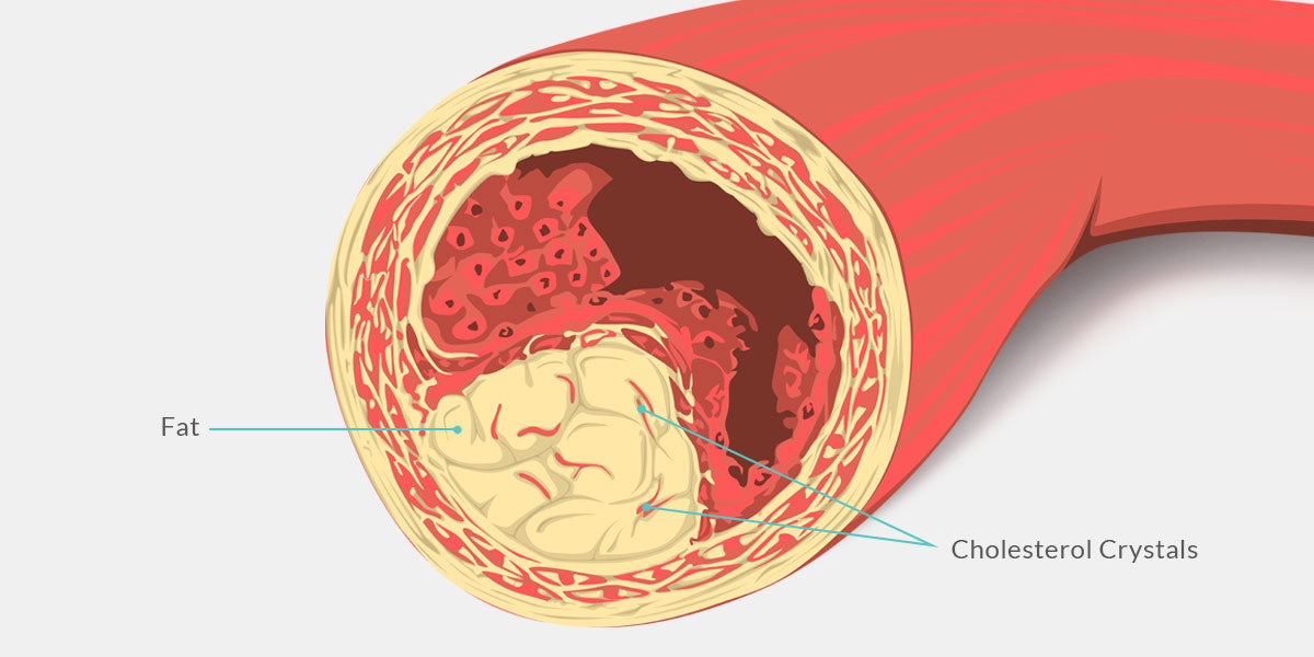 Cholesterol filled artery Illustration