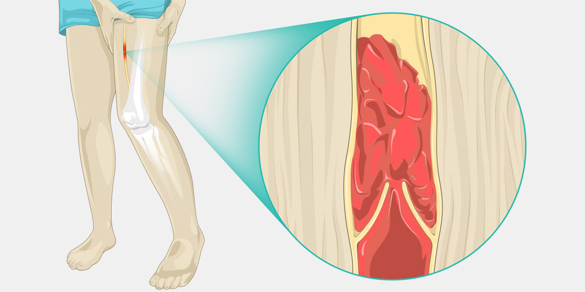 DVT Diagram