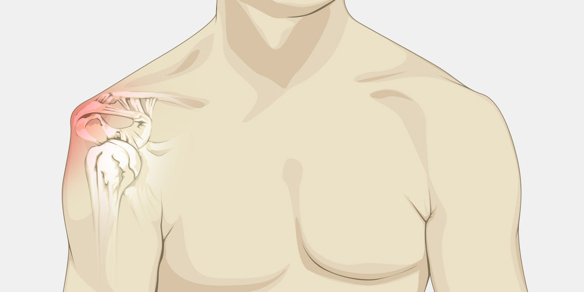 Shoulder Disclocation Illustration