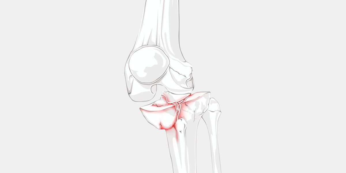 Fractured Knee Illustration