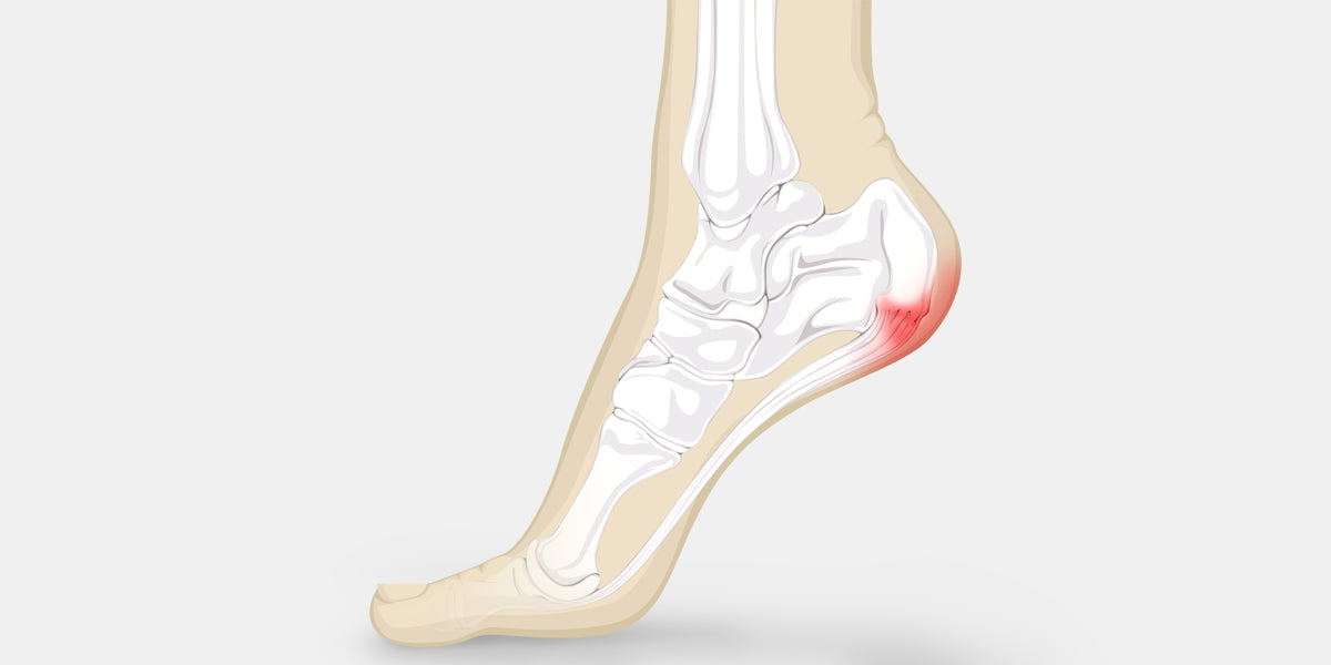 Heel Pain Illustration