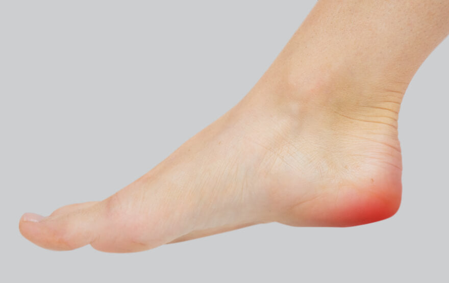 Is Your Heel Pain A Heel Spur Or Something Else?