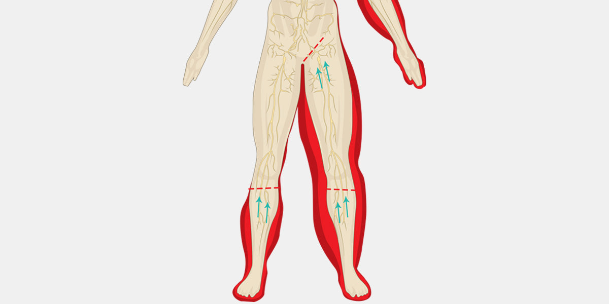 Lymphedema Diagram