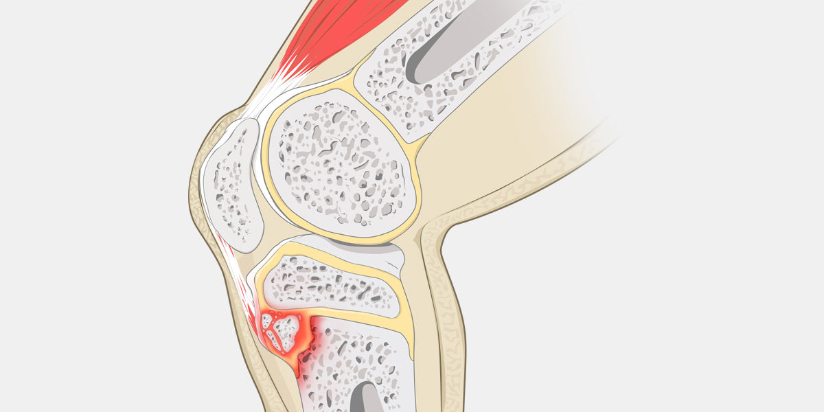 Osgood schlatter disease illustration