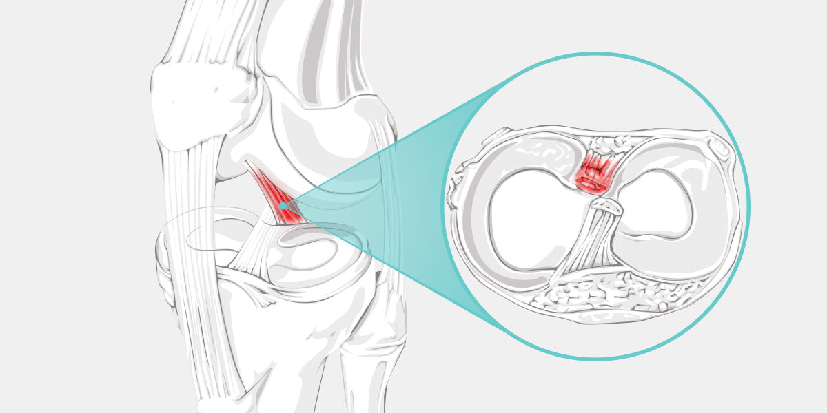 PCL Tear Illustration