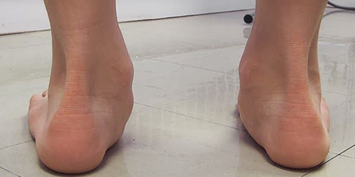 posterior tibial tendonitis insoles